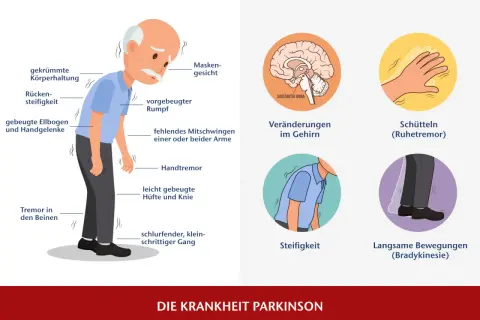 Illustration zeigt Parkinson-Symptome: gekrümmte Haltung, Tremor, Steifigkeit, veränderter Gang und Gehirnveränderungen.