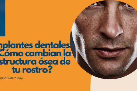 Primer plano de un rostro masculino con texto que pregunta cómo los implantes dentales cambian la estructura ósea.