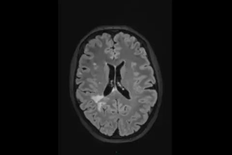 IRM cérébrale montrant des hypersignaux de la substance blanche, potentiellement liés au stress chronique ou à d'autres facteurs vasculaires.