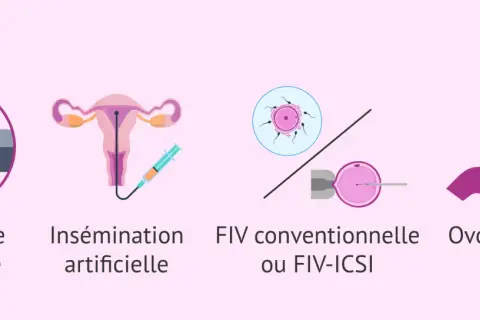 Illustrations de différentes méthodes pour concevoir un enfant, de la grossesse naturelle à l'ovodonation, utiles pour les femmes atteintes d'endométriose.