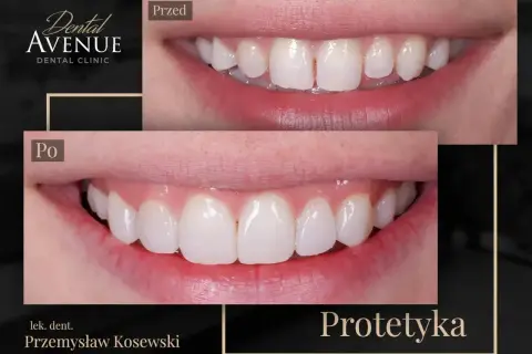 Przed i po: uśmiech po zabiegu bonding kompozytowy. Zęby idealnie równe i białe.