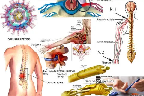 Illustrazione di compressione nervosa, virus erpetico e mielina danneggiata, con sintomi di nervo lesionato.