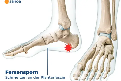 Knochenmodell eines Fußes mit hervorgehobenem Fersensporn hinten, der Schmerzen an der Plantarfaszie verursacht.