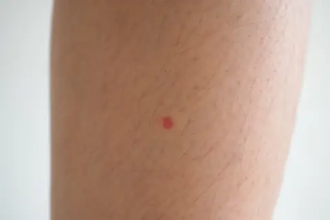 Una pequeña mancha roja en la pierna, quizás una picadura de insecto, resalta sobre la piel con vello.