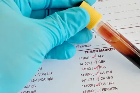 Ręka w niebieskiej rękawiczce trzyma probówkę z krwią nad listą markerów nowotworowych, gdzie zaznaczono CA 19-9.