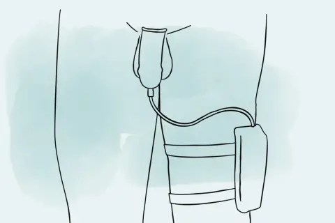 Illustration zeigt, wie man ein Urinalkondom anlegt. Ein Schlauch verbindet das Kondom mit einem Auffangbeutel am Bein.