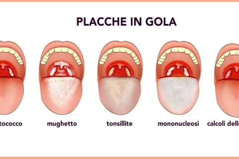 Illustrazione di cinque bocche aperte che mostrano diverse condizioni della gola, tra cui placche e calcoli tonsillari.