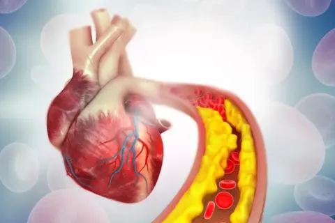 Serce z zatkanym naczyniem krwionośnym, gdzie cholesterol nie-HDL tworzy żółte złogi, utrudniając przepływ czerwonych krwinek.