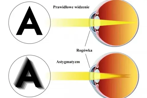 Astygmatyzm: Jak skutecznie korygować i trwale usunąć wadę?