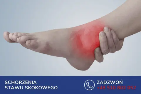 Stopa z zaznaczonym na czerwono bólem w okolicy stawu skokowego.