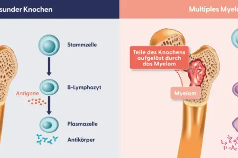 Erster Schritt der Therapie: gesunder Knochen vs. multiples Myelom. Myelomzellen schädigen Knochen und produzieren fehlerhafte Antikörper.