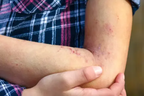 Czy cukinia uczula? Objawy alergii, które warto znać