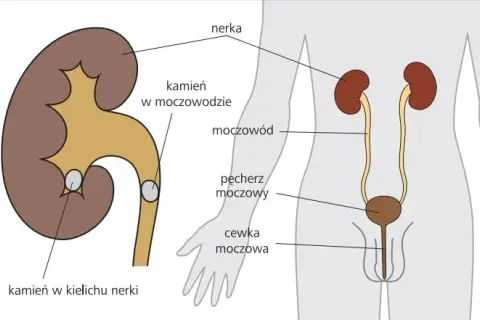 Czy badanie moczu wykryje kamicę nerkową? Sprawdź, co musisz wiedzieć