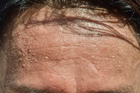 Frente sudorosa, con gotas de agua brillando. Busca trucos para no sudar por la cabeza y mantenerte fresco.