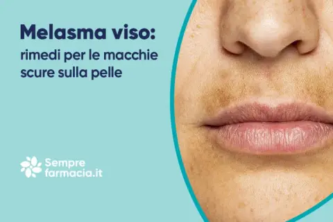 Primo piano del viso con melasma, evidenziando le macchie scure sulla pelle.