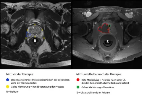 MRT-Aufnahmen zeigen metastasierten Prostatakrebs vor und nach Therapie. Links: Prostatakarzinom (blau) und Prostata-Rand (gelb). Rechts: Nekrose (rot) nach MRgFUS.