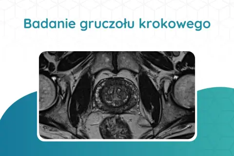 Tomografia prostaty: przekrój przez miednicę ukazujący gruczoł krokowy, pęcherz moczowy i inne struktury.