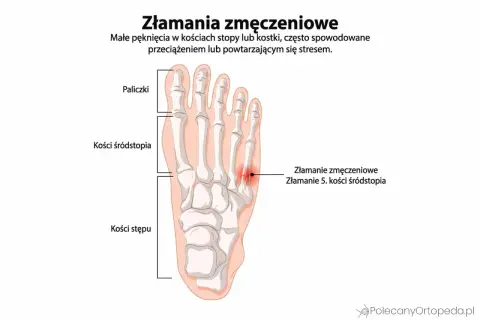 Anatomia stopy z zaznaczonym złamaniem zmęczeniowym 5. kości śródstopia.