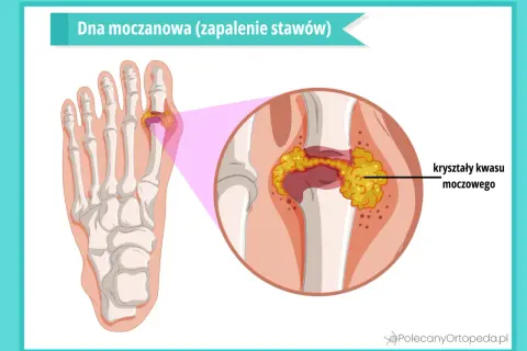 Ilustracja przedstawia staw palucha z kryształami kwasu moczowego, co jest przyczyną artretyzmu.