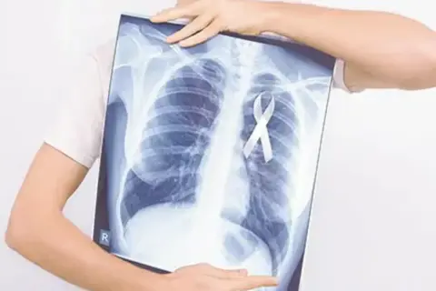 Rentgen klatki piersiowej z białą wstążką symbolizującą nadzieję na leczenie, np. pembrolizumabem.