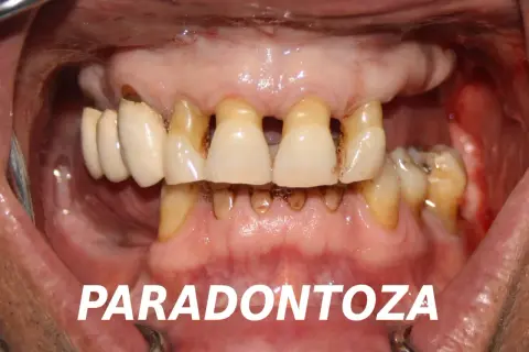 Zaawansowana paradontoza z widocznymi ubytkami kości i zębów. Rozważenie implantów jako rozwiązania problemu.