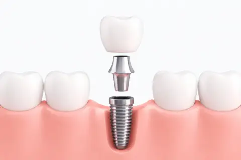 Componentes de un implante dental: tornillo, pilar y corona, listos para ser ensamblados en la encía.
