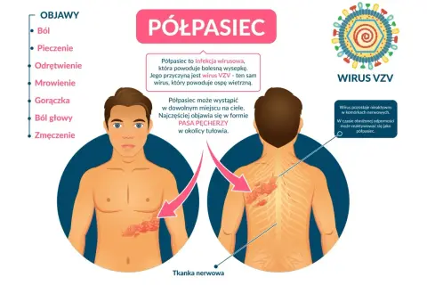 Półpasiec to wirusowa choroba objawiająca się bólem i wysypką. Czy półpasiec jest zaraźliwy? Nie, ale wirus VZV może się reaktywować.