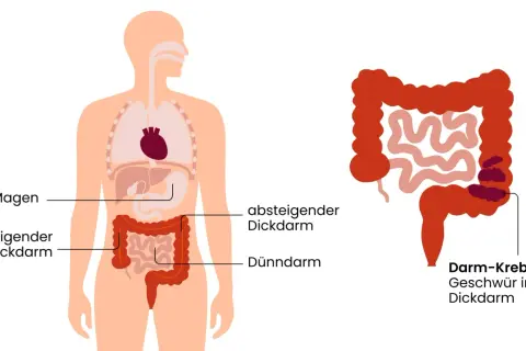 Illustration zeigt den menschlichen Verdauungstrakt mit Markierungen für Magen, Dickdarm und Dünndarm. Rechts ist ein vergrößerter Dickdarm mit einem Geschwür abgebildet, das auf Darmkrebs im Dickdarm hinweist.