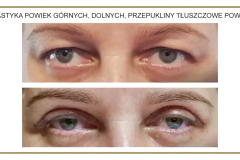 Przed i po zabiegu usunięcia przepukliny tłuszczowej powiek górnych. Widoczne zmiany w wyglądzie okolic oczu.