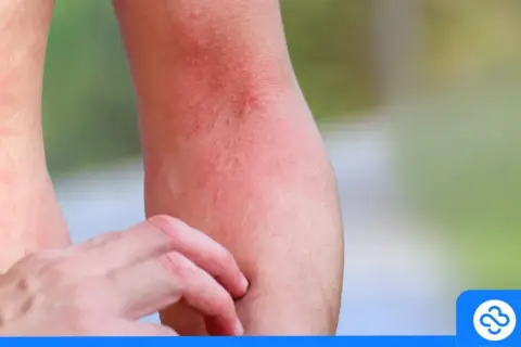 Alergia na leki: Rozpoznaj objawy i działaj! Poradnik krok po kroku