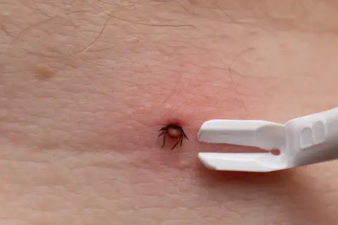 Kleszcz wbity w skórę, obok specjalne szczypce do jego usuwania. Czy kleszcz może wejść pod skórę? Nie, ale wgryza się głęboko.