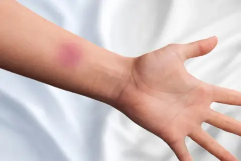 Ein blauer Fleck am Unterarm, der mit Arnika gegen blaue Flecken behandelt wird.
