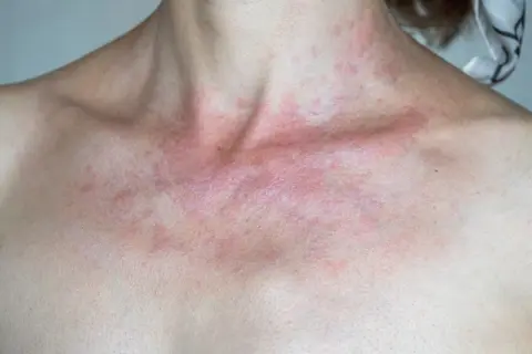 Widoczna zaczerwieniona wysypka na klatce piersiowej i szyi, z widocznymi grudkami i łuszczeniem.