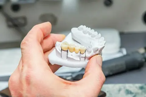 Model szczęki z widocznym, wykonanym z porcelany mostkiem na zębach.