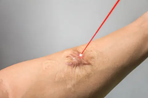 Czerwony promień lasera skierowany na bliznę na skórze ramienia, symbolizujący nowoczesne leczenie blizn.