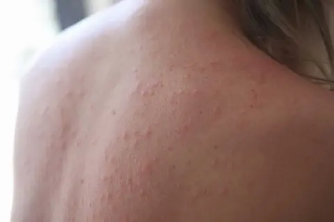 När barn får soleksem kan det se ut så här på ryggen, med små röda prickar och utslag.