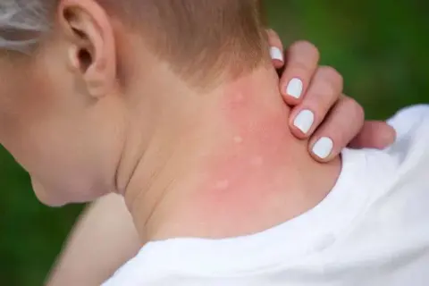 Alergia na gluten objawy skórne: jak je rozpoznać i leczyć