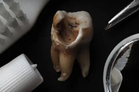 Zniszczony ząb z widoczną próchnicą na powierzchni. Obok szczoteczka, pasta i lusterko dentystyczne.