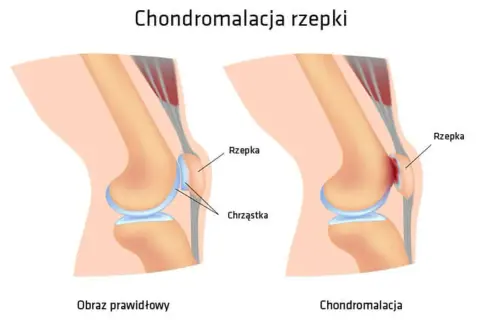 Ilustracja porównująca prawidłowe kolano z kolanem z chondromalacją rzepki.