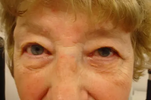 Nahaufnahme eines Gesichts mit Falten um die Augen. Ein gelblicher Fleck ist am rechten Unterlid sichtbar, ein mögliches Symptom eines Aderhautmelanoms.