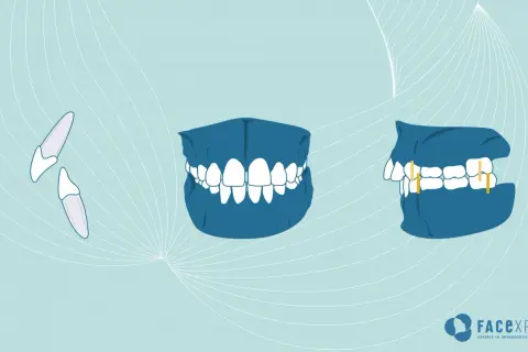 Illustrazione di denti sporgenti, prima e dopo il trattamento ortodontico.