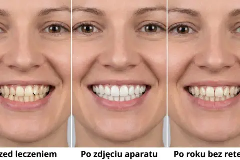 Uśmiech przed leczeniem, po zdjęciu aparatu stałego i po roku bez retencji. Widać znaczącą poprawę.