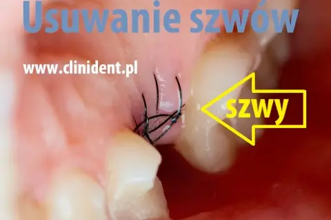 Zdjęcie szwów u dentysty: Koszt, NFZ i jak zaoszczędzić?