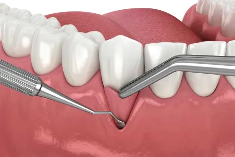 Ilustración dental que muestra el inicio de un trasplante de encía, con instrumentos quirúrgicos listos para el procedimiento.