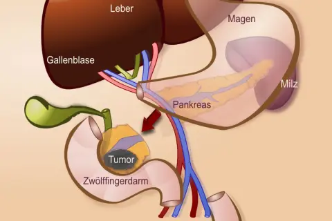 Anatomische Darstellung des Pankreas, Zwölffingerdarms und der Gallenblase mit einem Tumor. Zeigt den Bereich für eine partielle duodenopankreatektomie.