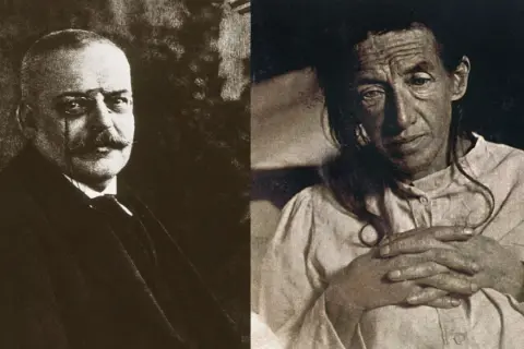 Alois Alzheimer, der Namensgeber der Krankheit, und eine Patientin, deren Fall er dokumentierte.