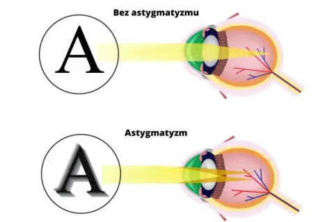 Jak astygmatyk widzi litery? Wyjaśniamy objawy i korekcję