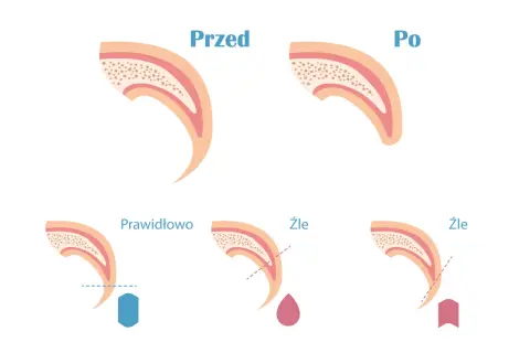 Ilustracja pokazuje, jak obciąć pazury psu który się wyrywa. Prawidłowe cięcie jest pokazane z niebieskim obcinaczem, a złe cięcie z krwawiącą kroplą lub obcinaczem zbyt blisko nerwu.