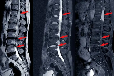 Obraz MRI kręgosłupa lędźwiowego z widocznymi zwężeniami kanału kręgowego (stenoza kanału kręgowego) zaznaczonymi czerwonymi strzałkami.