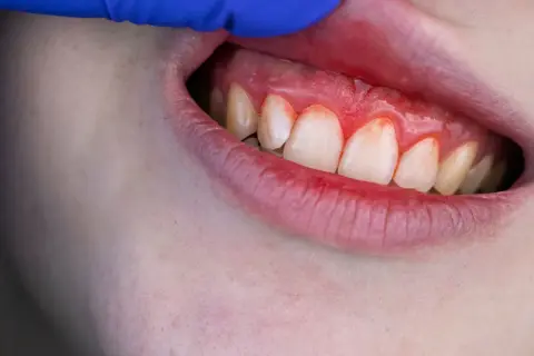 Encías inflamadas y rojas, indicando la necesidad de un tratamiento para encías sangrantes.